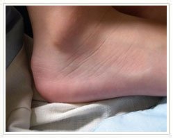 Slider image (8) Laser Foot Surgery Specialist | Spanish Patient Center